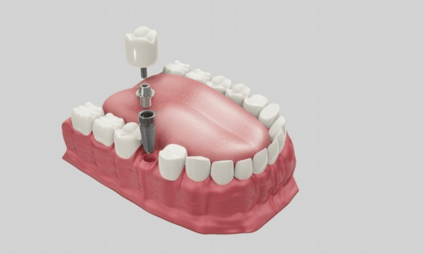 Implant Dentist Edinburg