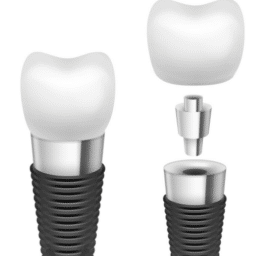 Dental Implant Edinburg